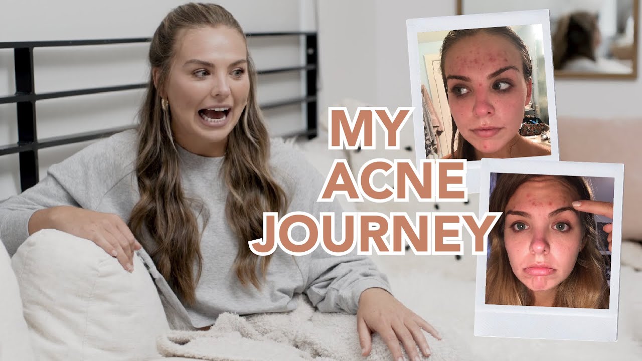 My Acne Journey!
