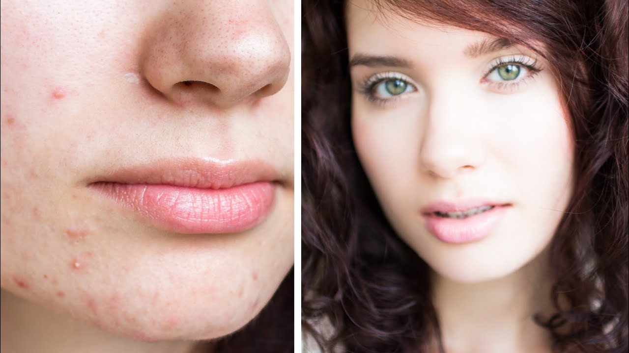 How To Cover Acne & Scars | My Full Coverage Mineral Foundation Routine - NON-COMEDOGENIC, NATURAL