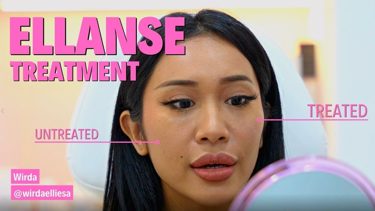Ellanse Treatment with Wirda