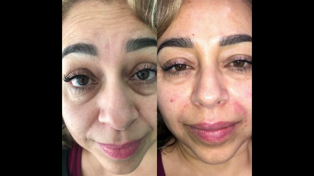 My 1st Full face YouthRestored 8 Years ago! 