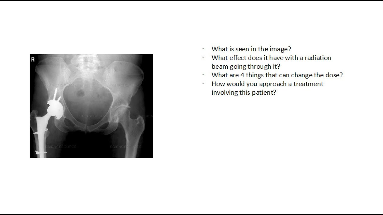 Hip Prosthetic in Radiotherapy ABR Part III Prep/Overview