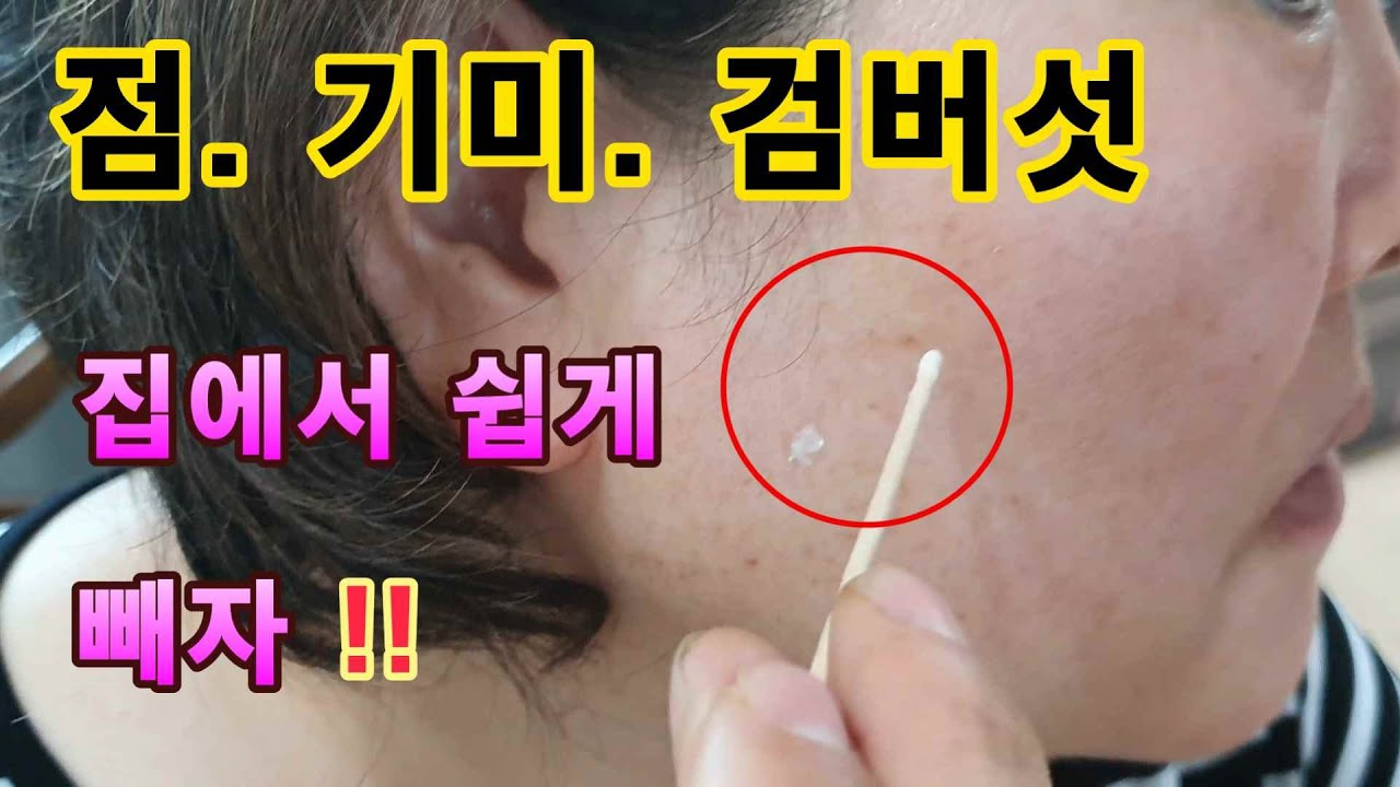 💥💖점. 검버섯. 기미. 제거 집에서 간단하고 쉽게!!( Mole. Black mushrooms. Flags. Simple and easy to remove at home. )