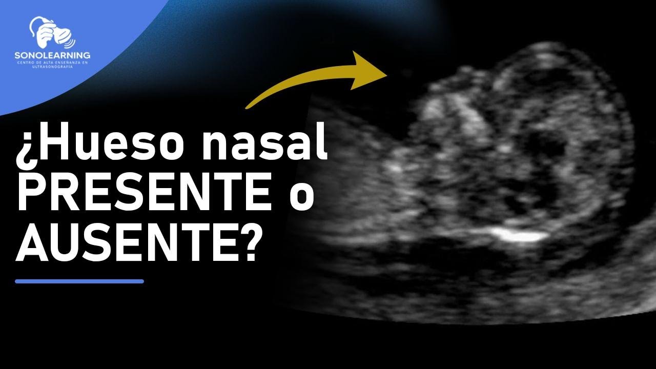 Hueso nasal ausente/hipopl&aacute;sico #ense&ntilde;anza #docencia #embarazo #ultrasound #ecografia #fetalmedicine