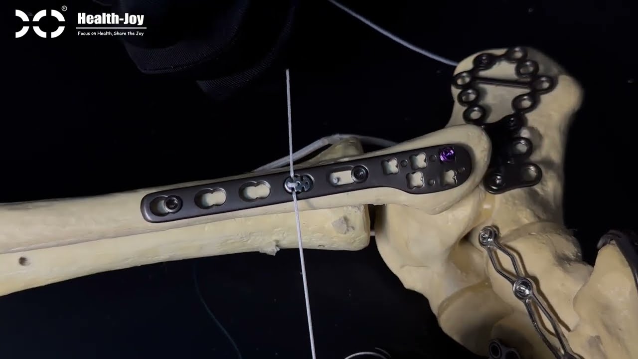 Distal Fibula Fracture Ankle Osteosynthesis