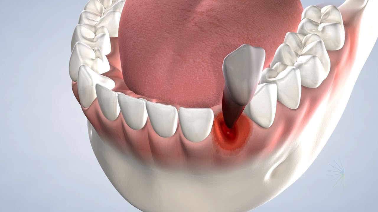 General Tooth Extraction in New Hudson, MI