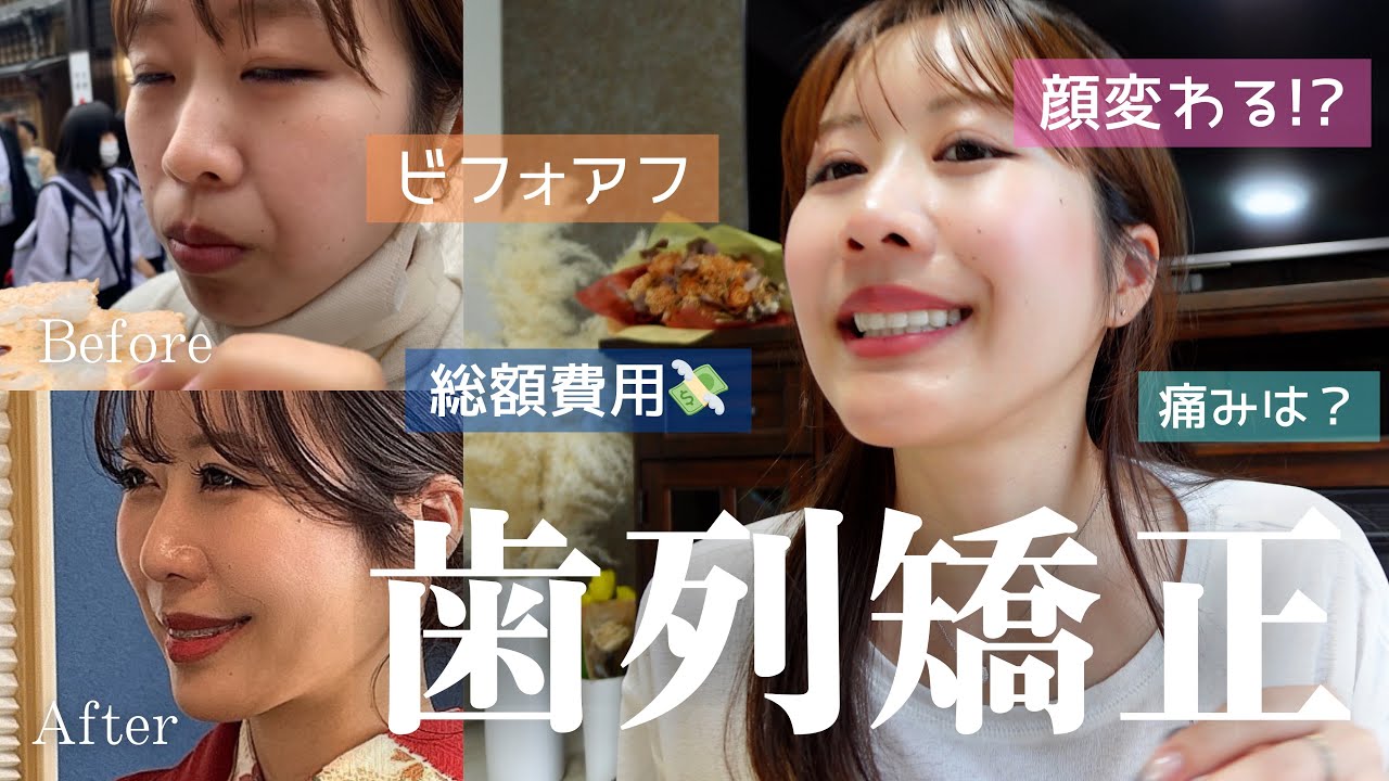 【歯列矯正】3年かかった矯正を終えての総額費用💸・ビフォアフター・経過など全て話します！