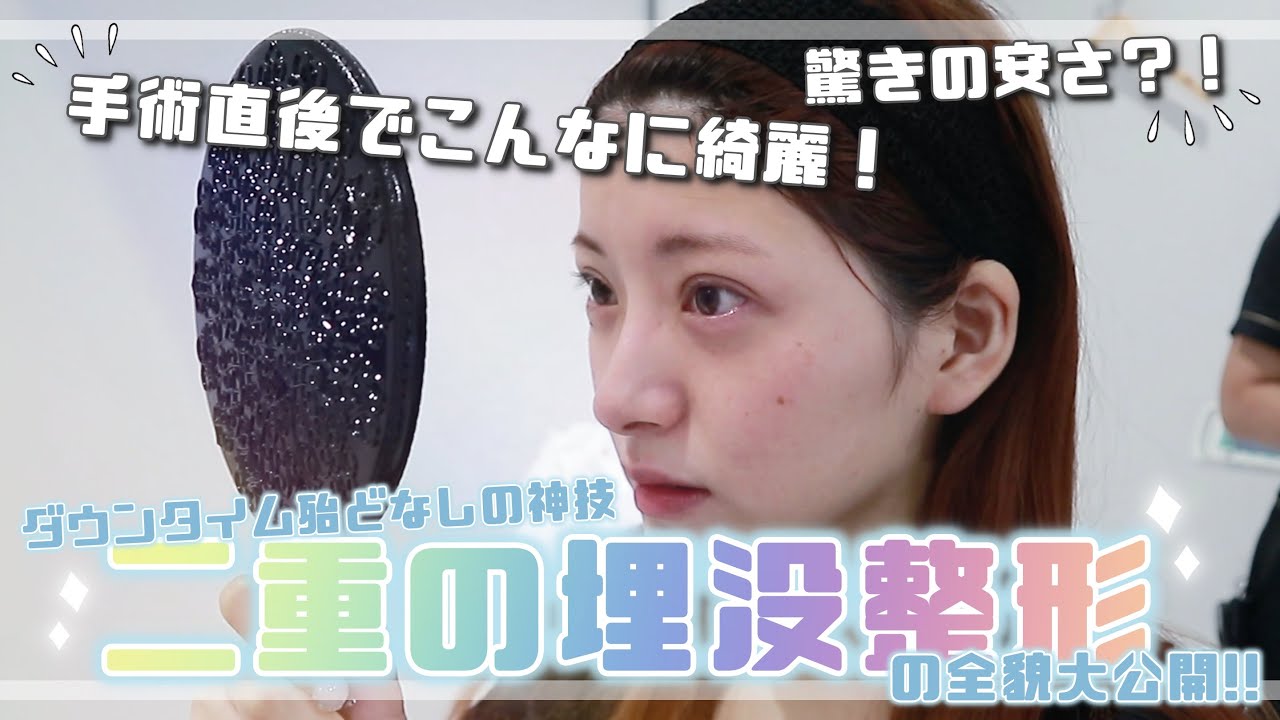 【整形動画】人生で2回目の二重の埋没整形をしてくれた帝王が神過ぎた【二重】