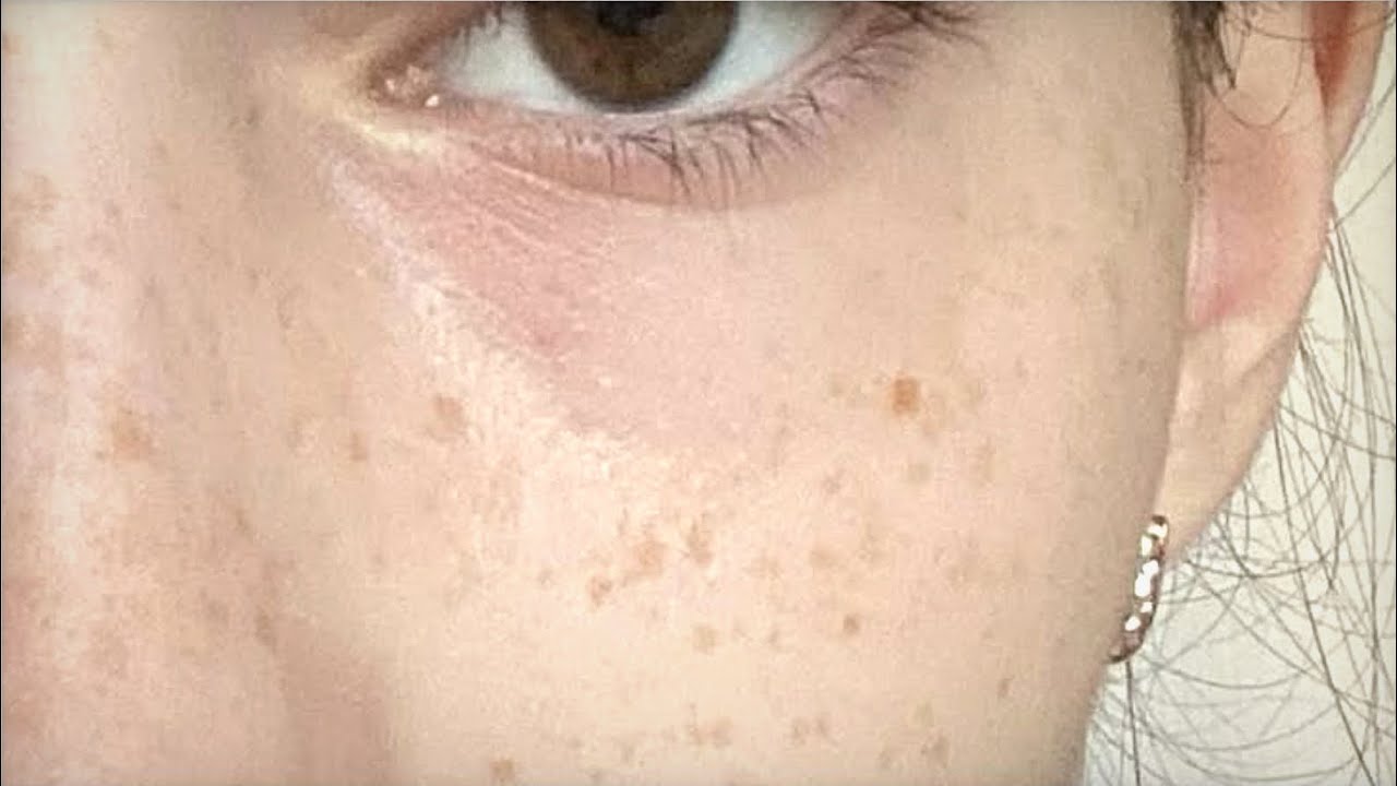 雀斑 | Sardas (forced subliminal)