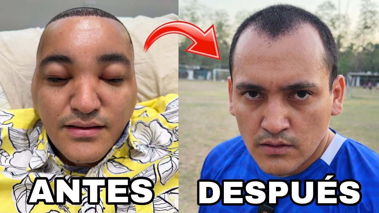 Un mes despu&eacute;s de MI OPERACI&Oacute;N | Atilio Larin