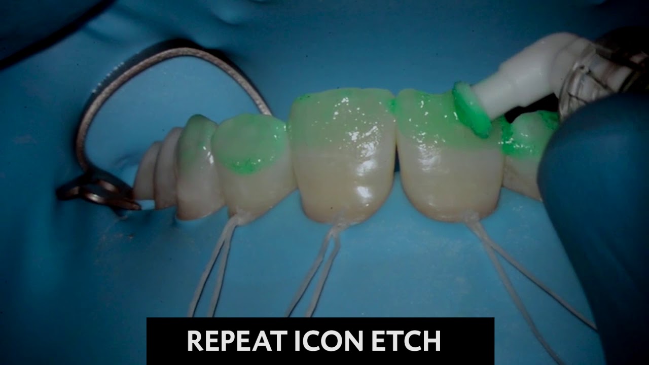Icon White Spot Lesion Treatment - Step 1: Enamel Preparation