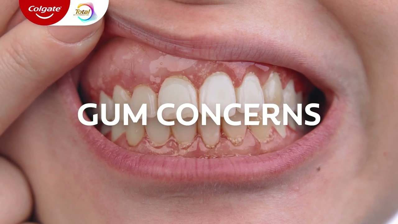Get ahead of gum concerns with Colgate Total!