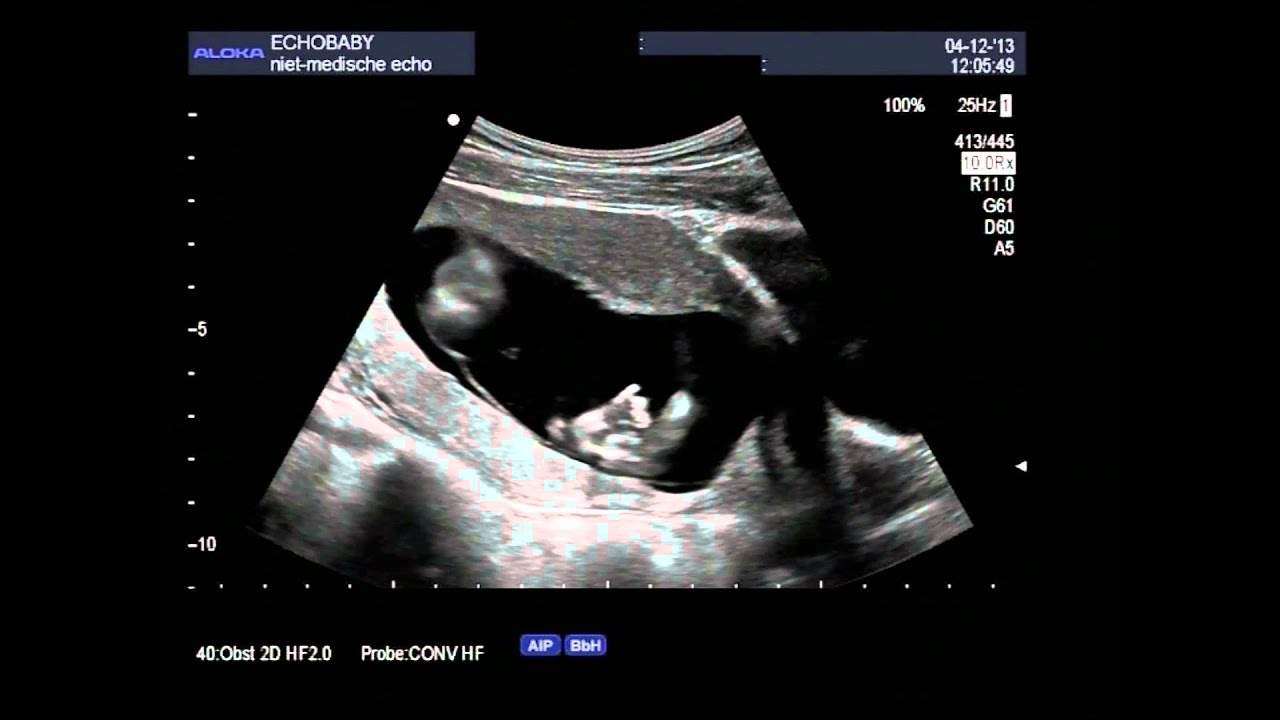 2D pretecho jongen 13 weken, met ingesproken uitleg