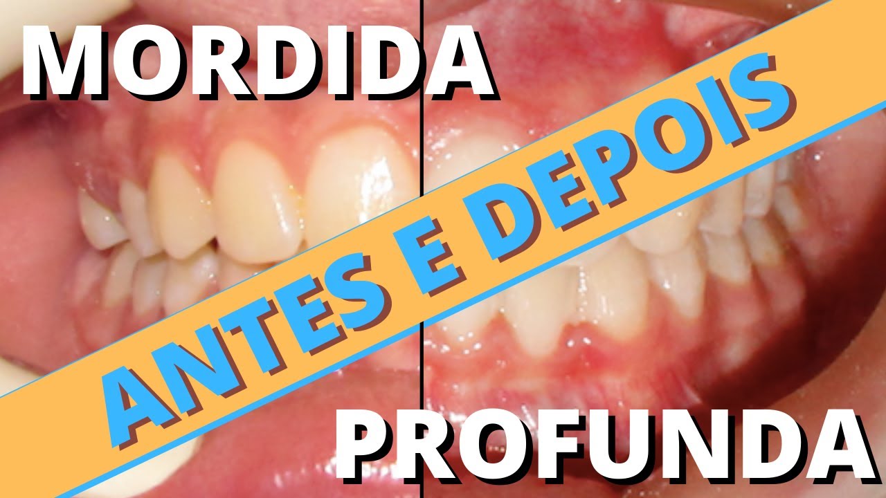 Mordida profunda antes e depois do aparelho