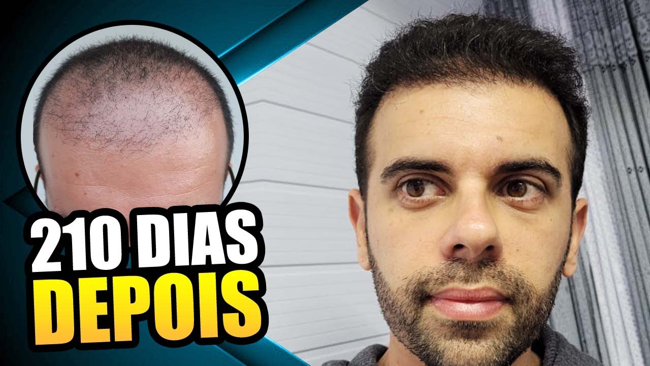 Transplante Capilar 7 Meses, Produtos que uso no Tratamento