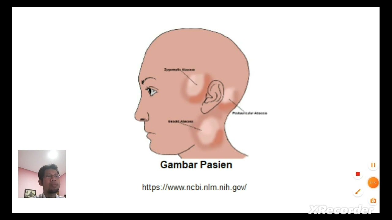 Mengenal Abses Bezold, Bengkak di pipi, lokasi di bawah telinga. Komplikasi dari mastoiditis