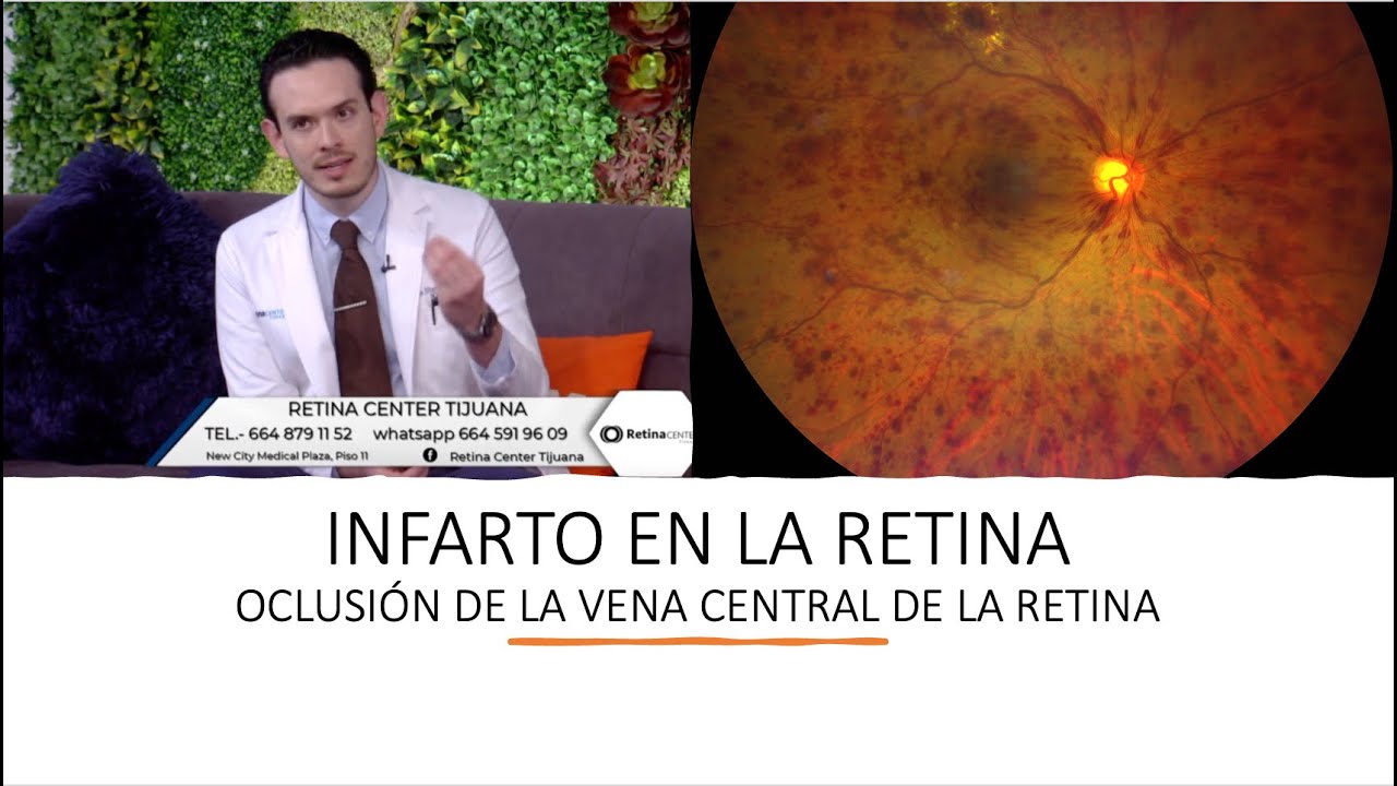 Infarto en la Retina | Oclusión de la vena central de la retina | Retina Center