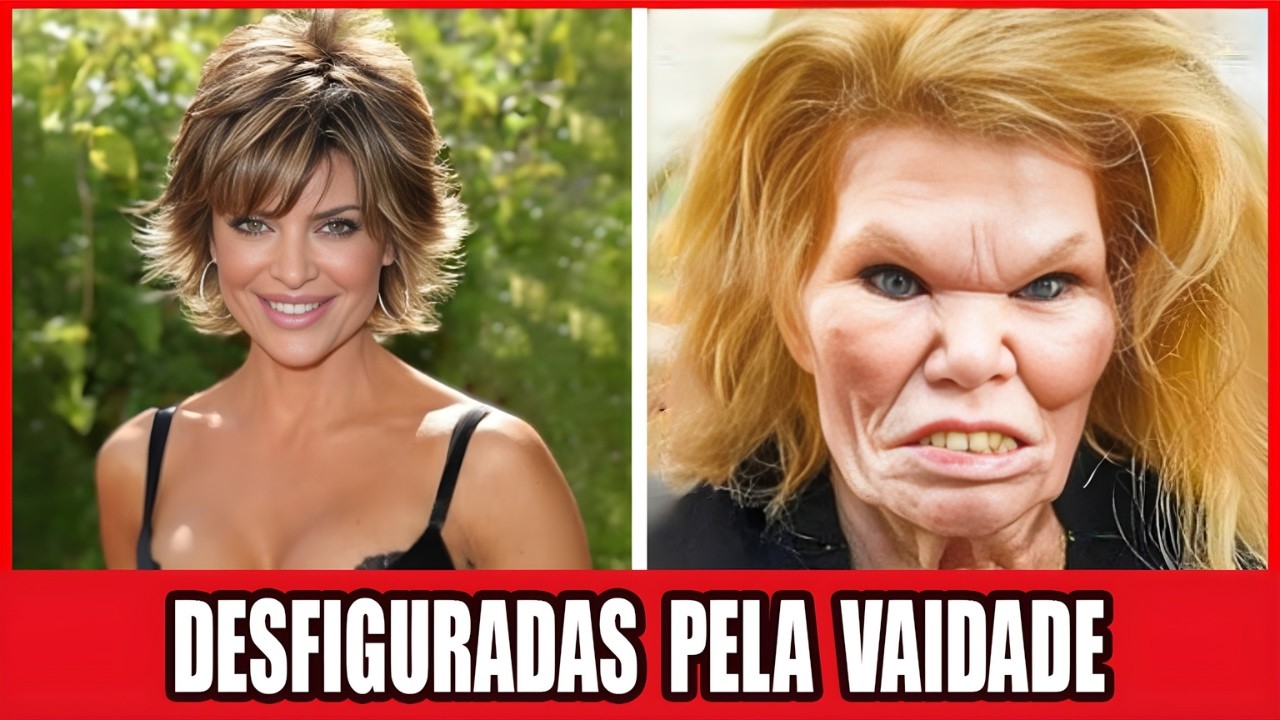 10 Estrelas De Hollywood Que Arruinaram A Aparência Com Cirurgias Plásticas | Antes E Depois 2026!