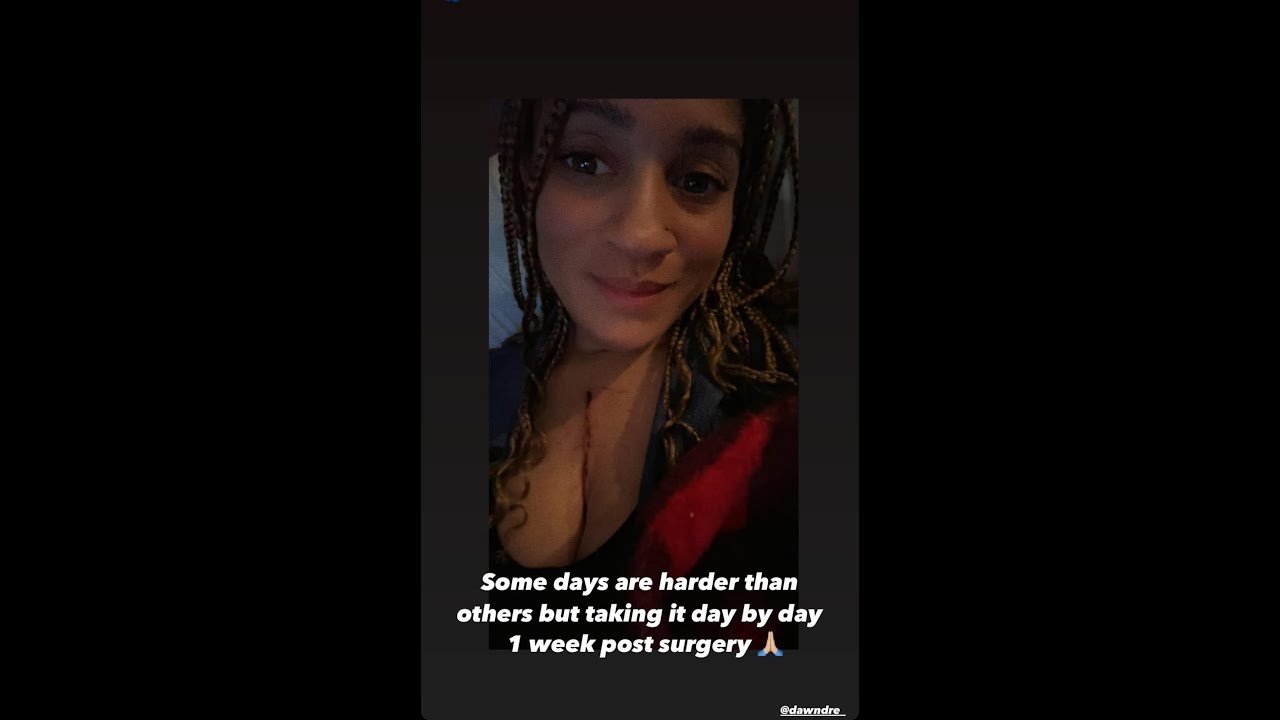 OPEN HEART SURGERY VLOG Aortic Bicuspid Valve Replacement (Reupload)