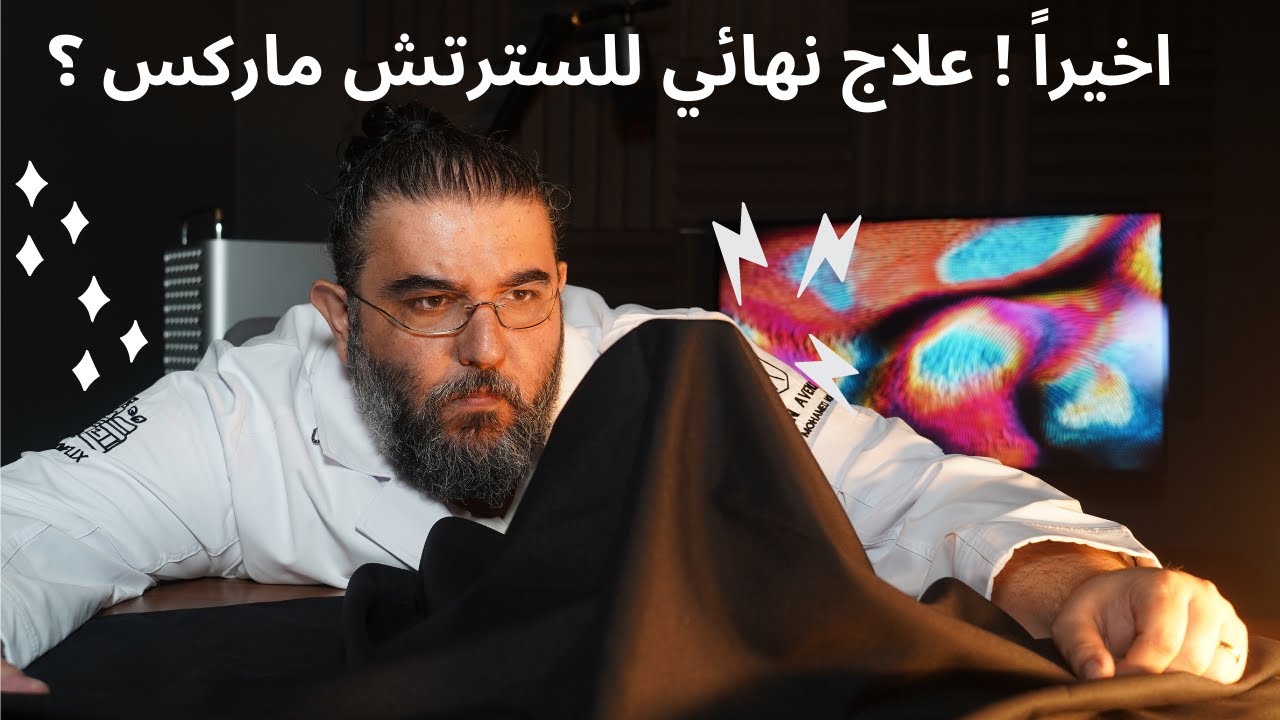 stretch marks | اخيراً ! علاج نهائي 