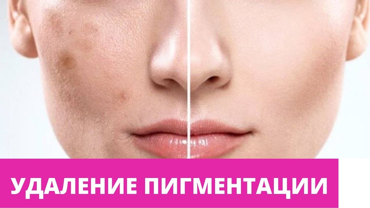 УДАЛЕНИЕ ПИГМЕНТАЦИИ НА АППАРАТЕ НОРДЛИС .