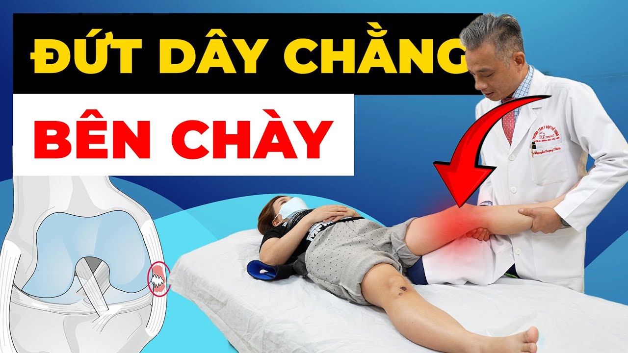 Đứt Dây Chằng Bên Chày Điều Trị Cực 