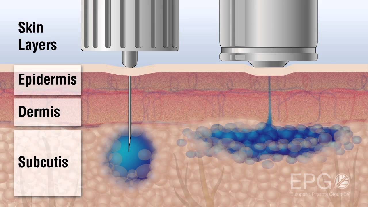Needle vs InsuJet™ Nozzle injection