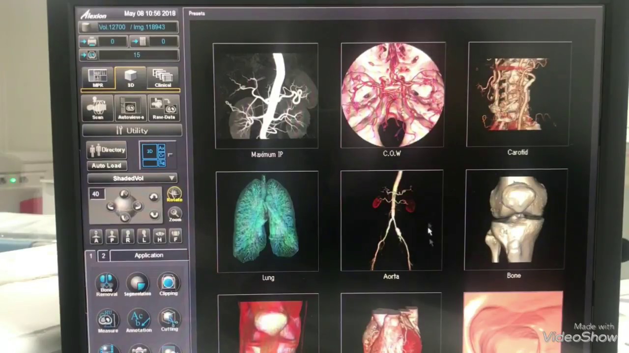 3D Metoduyla Ayak ve Ayak Bilegi BT Nasil Cekilir? Toshiba Alexion BT Cekmeyi Ogreniyorum