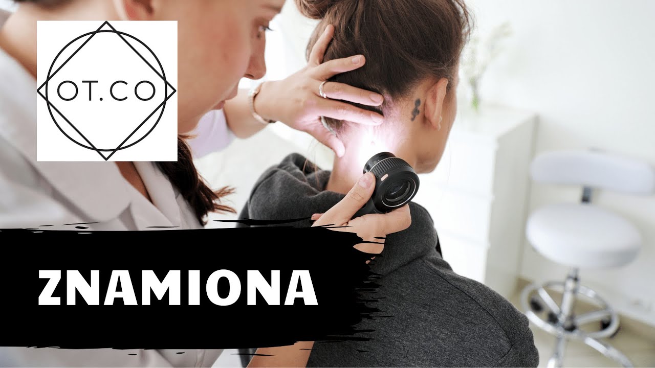 Znamiona, ich usuwanie, na co zwrócić uwagę, kiedy zgłosić się do lekarza - OT.CO Clinic