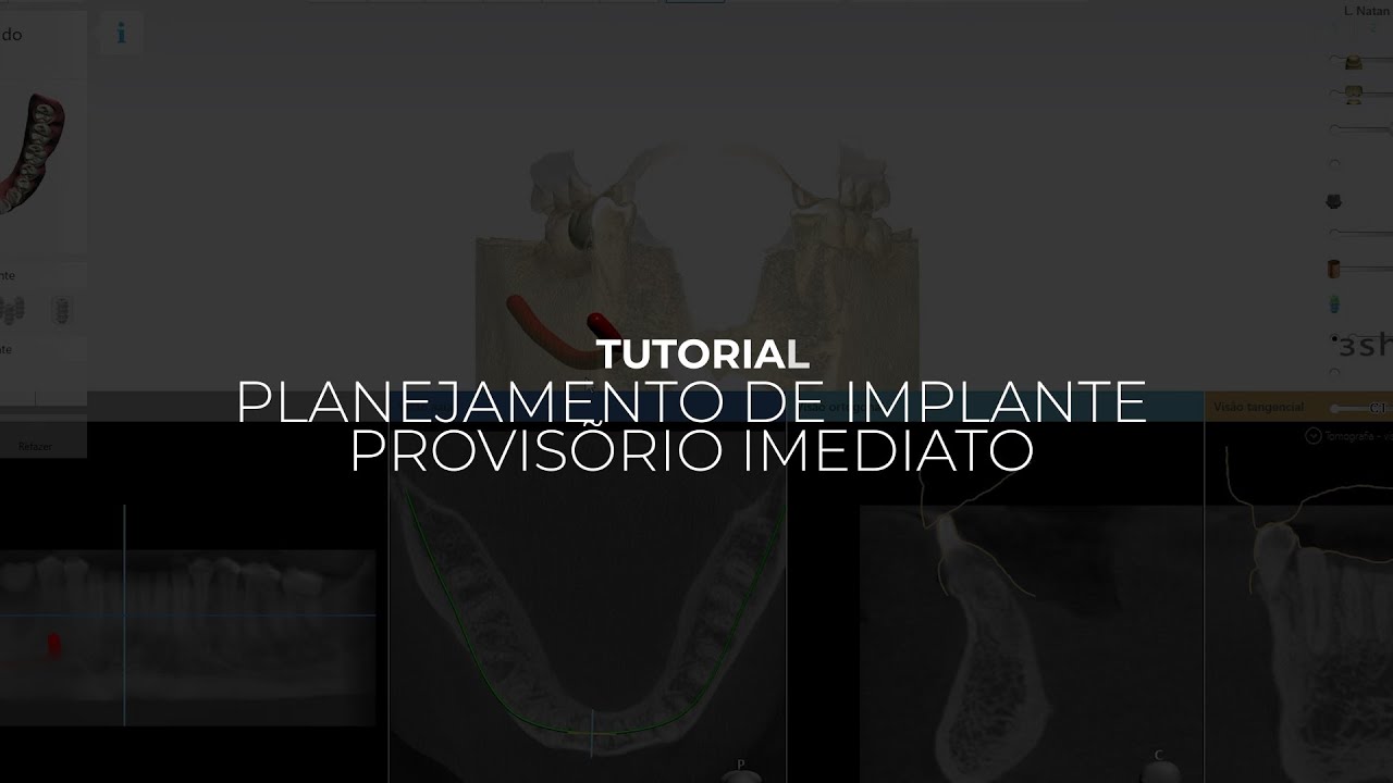 Implant Studio 3Shape | Como Criar um Provisório Imediato no Fluxo Digital (Parte 2)
