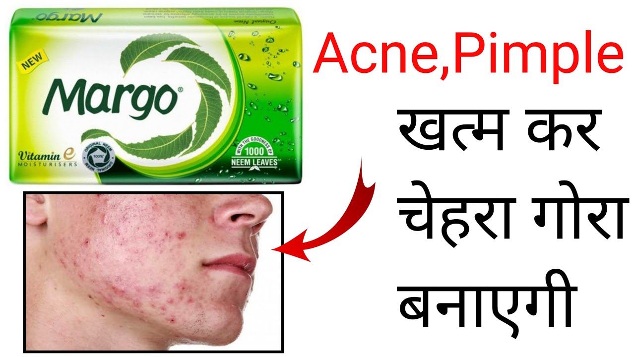 Margo Soap Review | margo neem soap review | margo sabun ke fayde