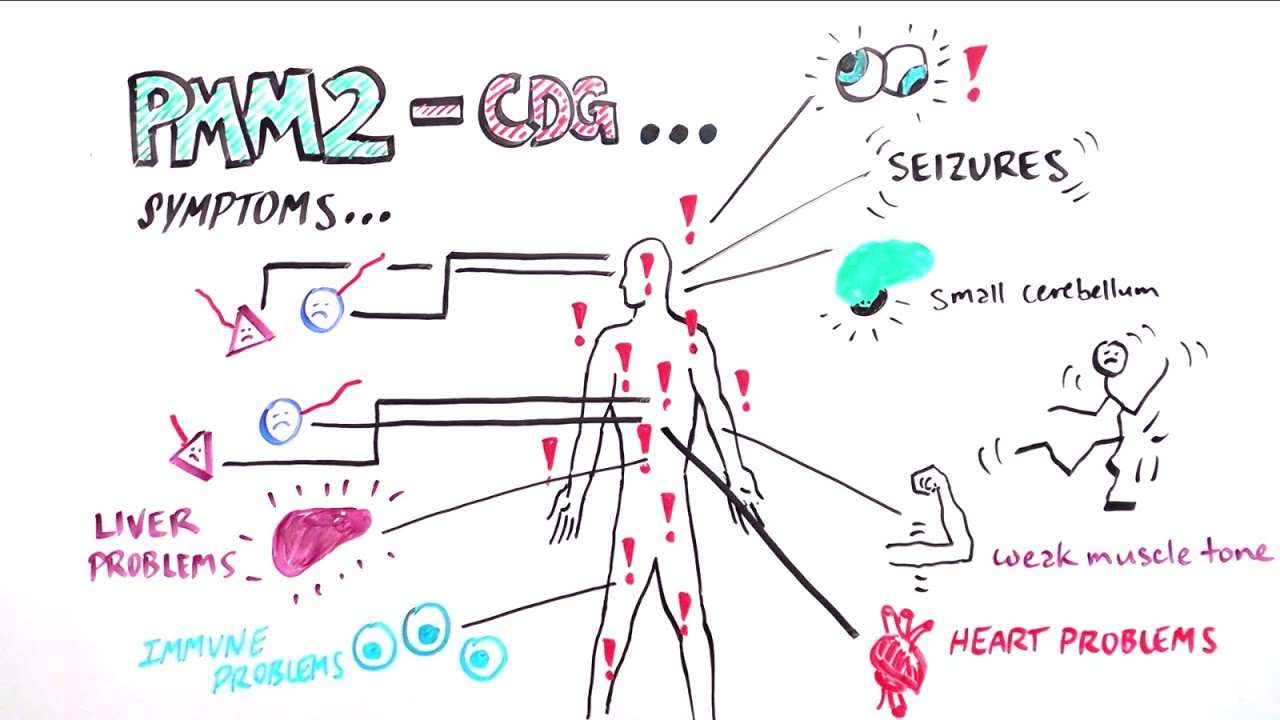 What is PMM2-CDG?