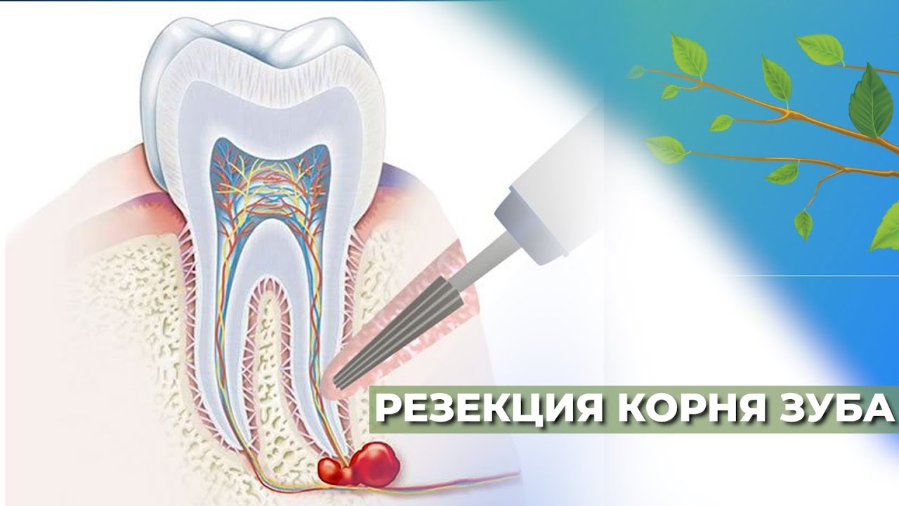 Резекция верхушки корня зуба☘️