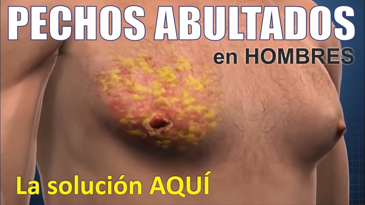 GINECOMASTIA O PSEUDOGINECOMASTIA 🙈 La soluci&oacute;n AQU&Iacute; 🤩 Dr Luis Vizcarra 🙌 CIRUG&Iacute;A PL&Aacute;STICA