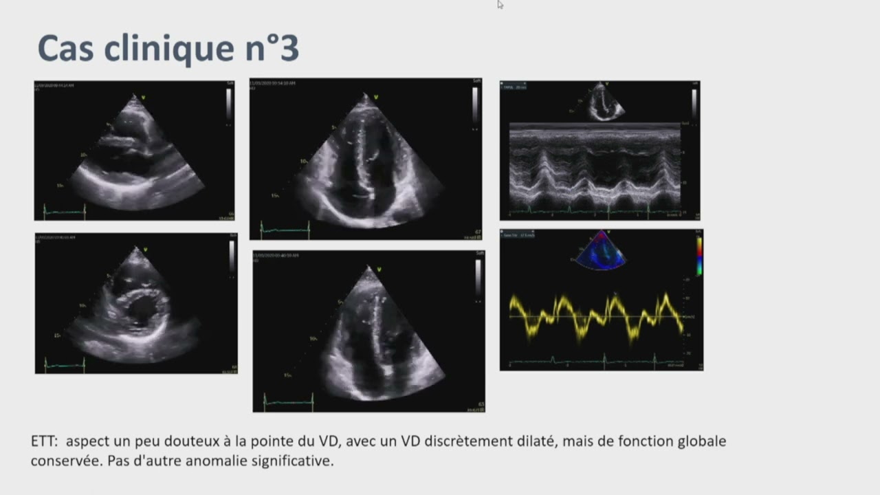Les cardiomyopathies