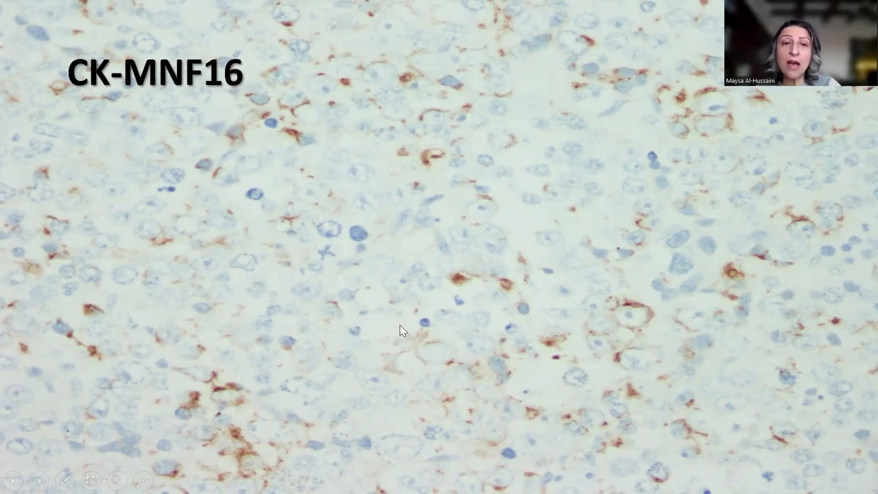 Tip-84;Large Cell NEC of the Ovary