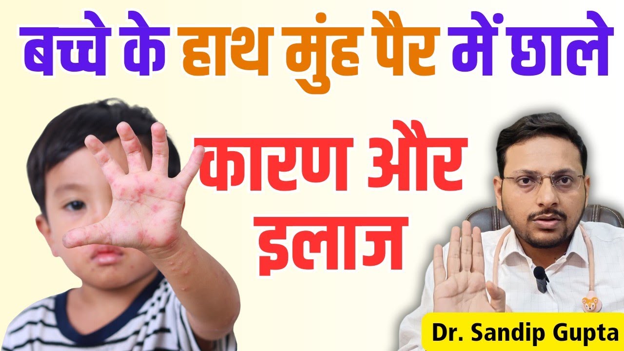Hand Foot Mouth Disease in Children : How to Prevent & Home Care of Hand Foot Mouth Disease