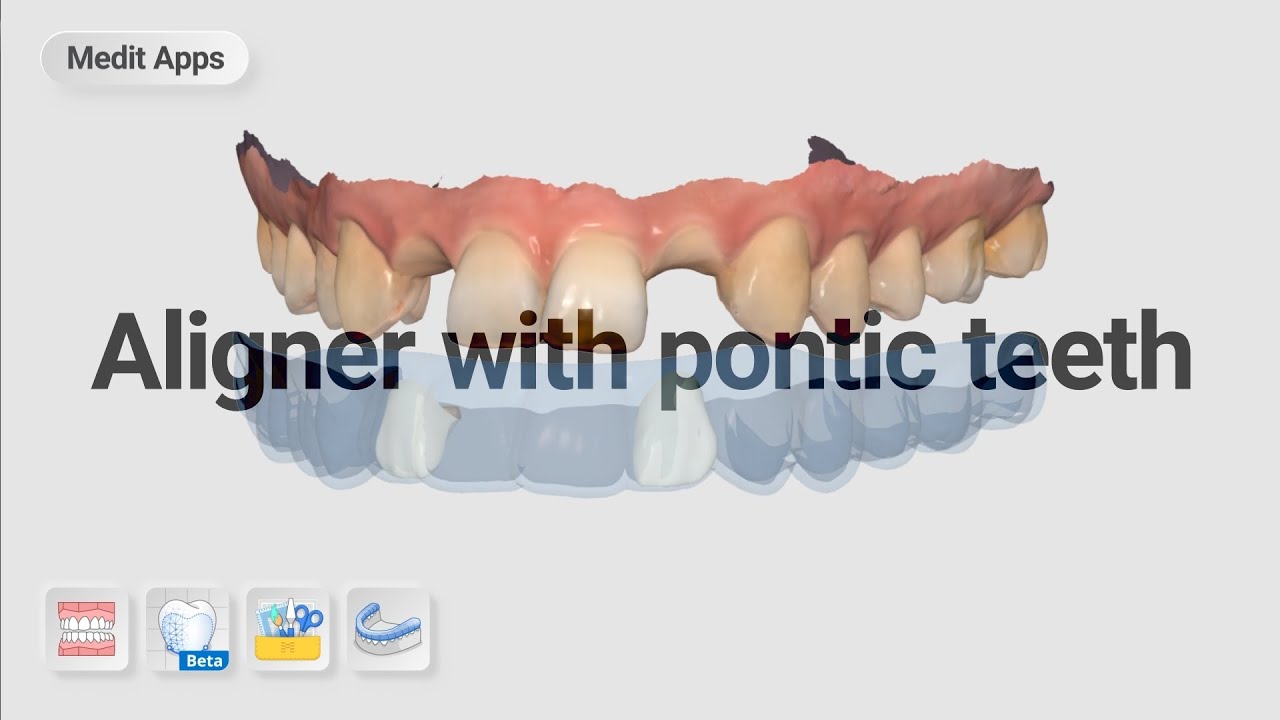 Designing an 'Aligner with pontic teeth'.