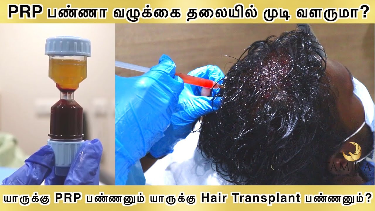 PRP (Platelet Rich Plasma) யாருக்கு பண்ணனும்? யாருக்கு Hair Transplant பண்ணனும்? Hair Loss Treatment