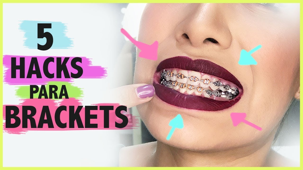 5 HACKS PARA QUIENES TIENEN BRACKETS!! Carel Quezada