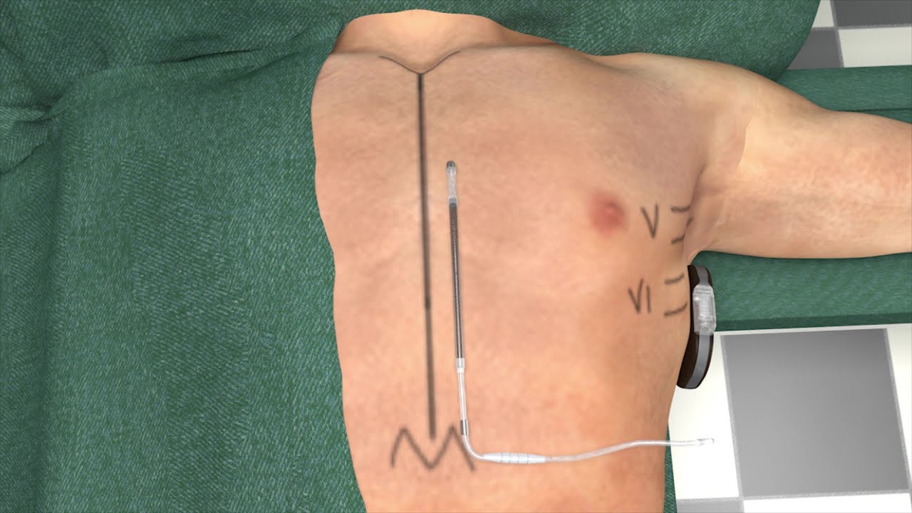 EMBLEM&trade; S-ICD: Intermuscular 2IT Technique Guide