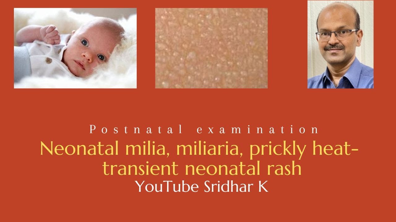 Neonatal milia l miliaria l prickly heat #newbornrash