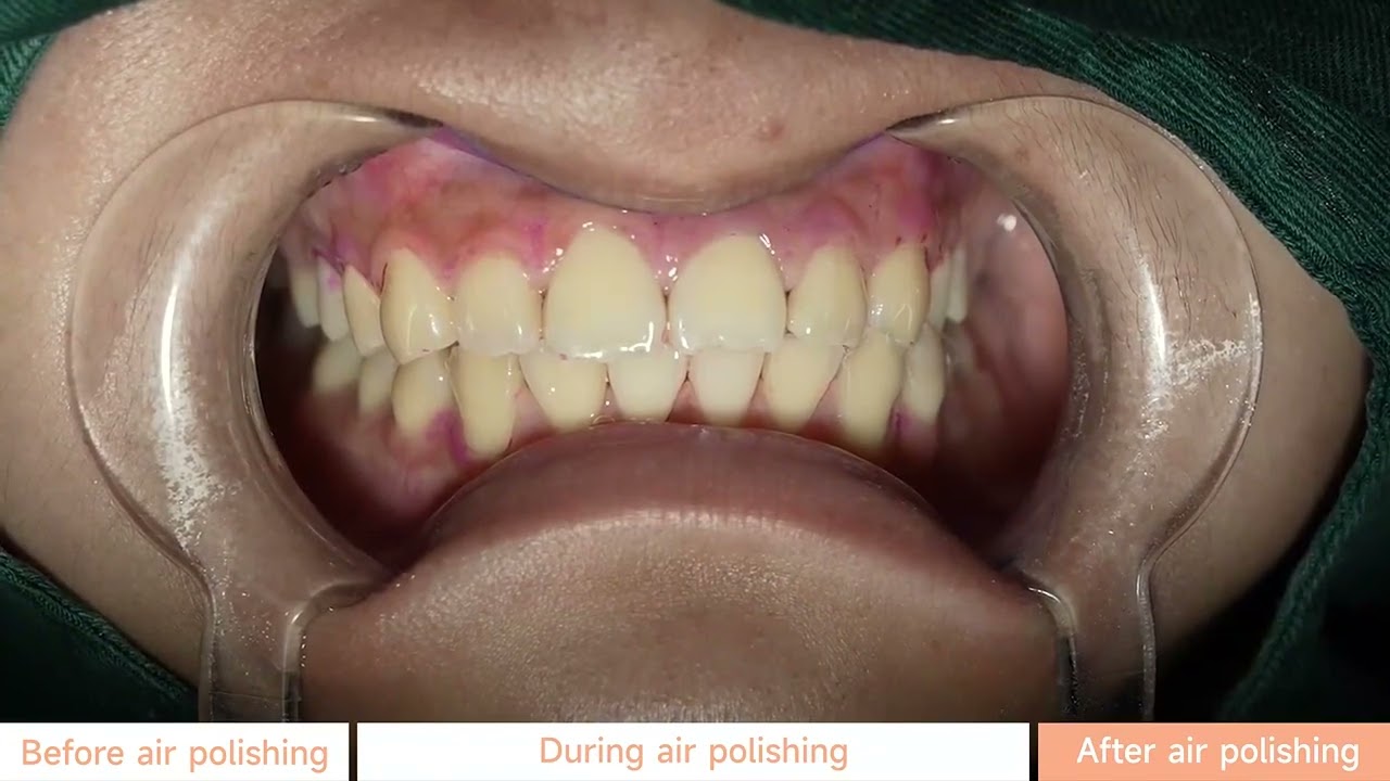 The introduction on Woodpecker AP-A Portable Dental Air Polisher - Dentalsalemall