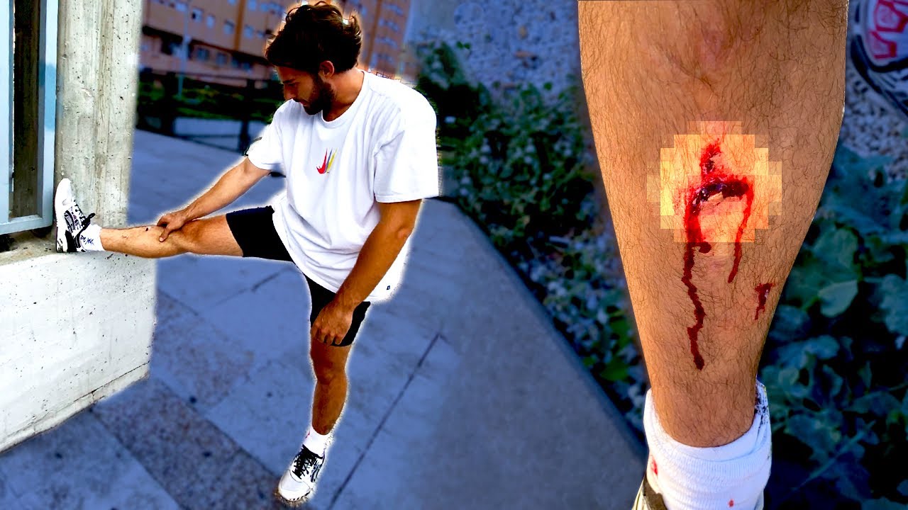ME REVENTÉ LA TIBIA…💥(puntos incluidos)