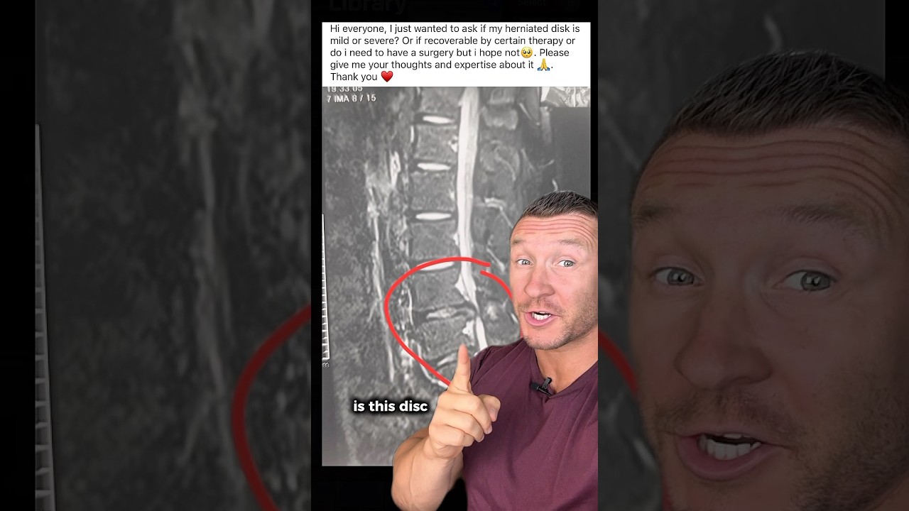 Severe Lumbar Disc Herniation?
