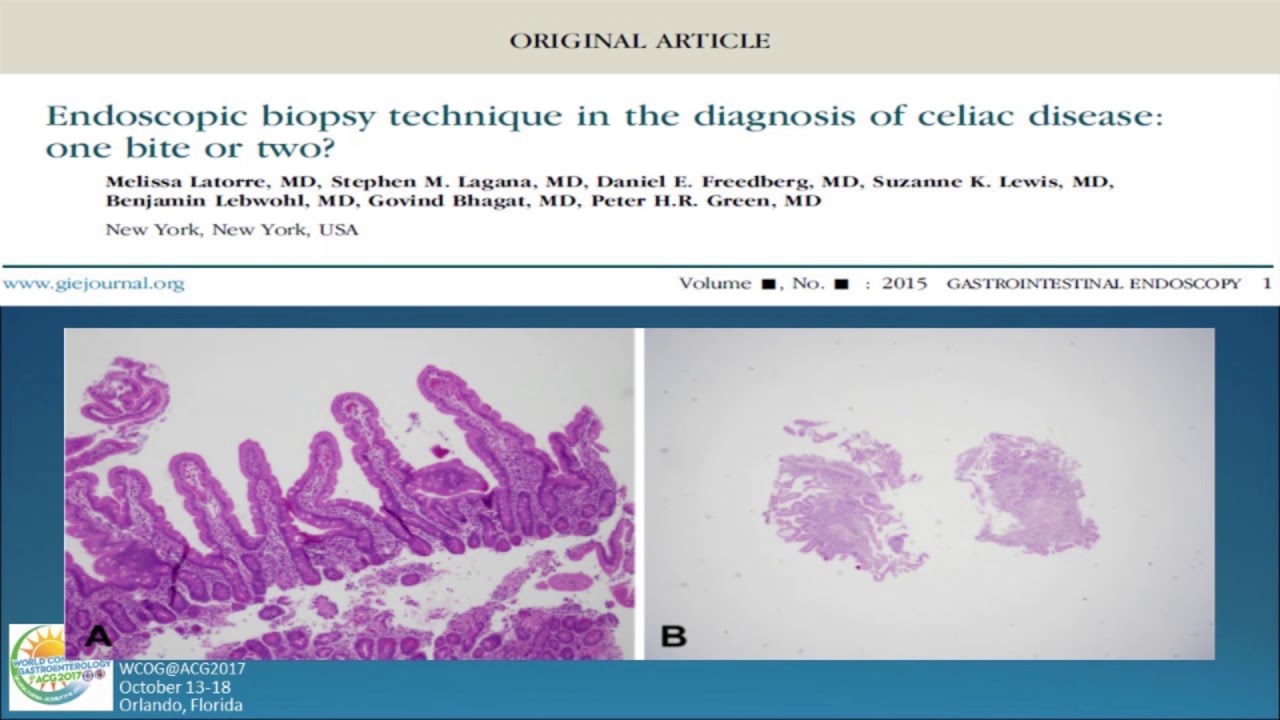 Celiac Disease: Novel Therapeutic Approaches Beyond Gluten Withdrawal