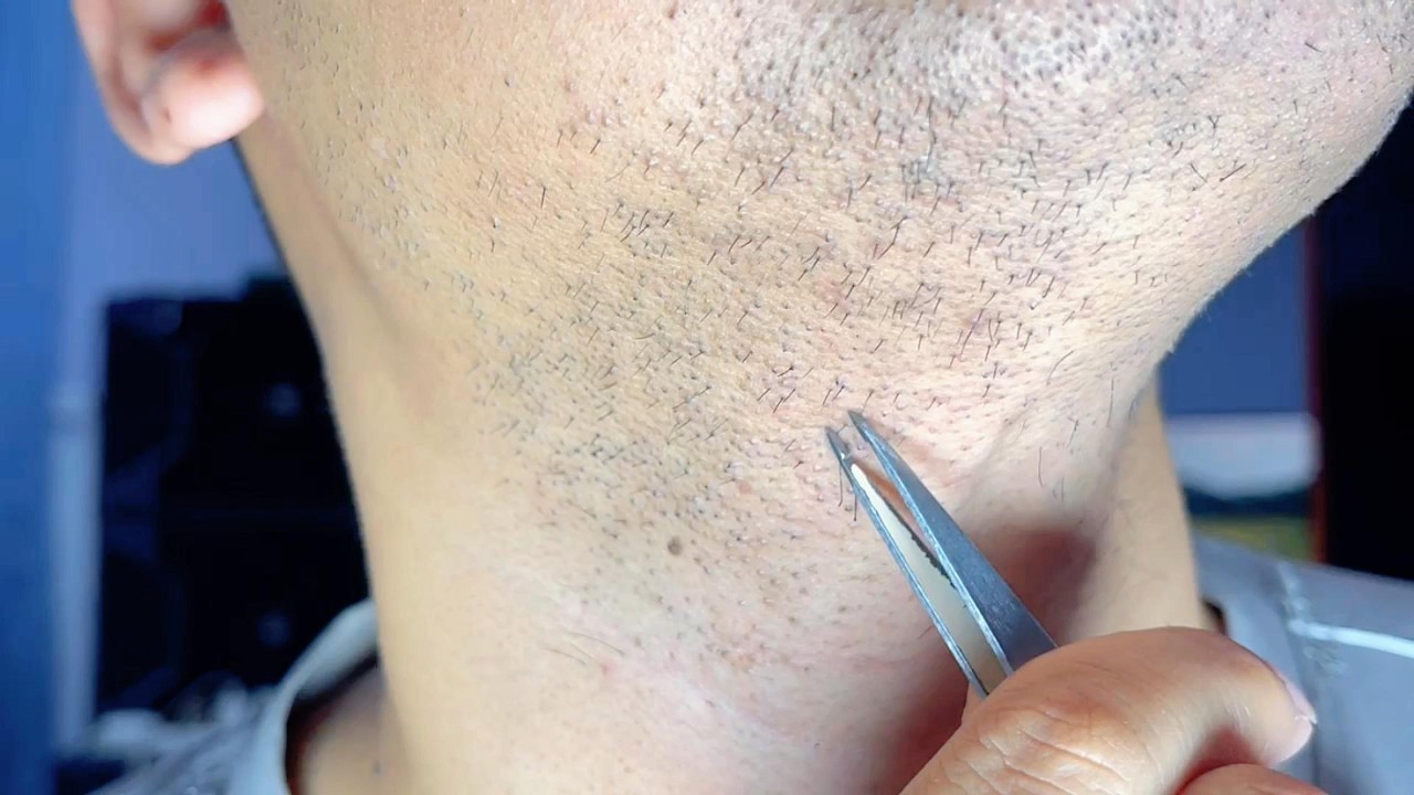 If You’re Relaxing, Here’s My Beard Care !!! #relaxing  #hair #chin #ingrownhair #asmr #tweezer