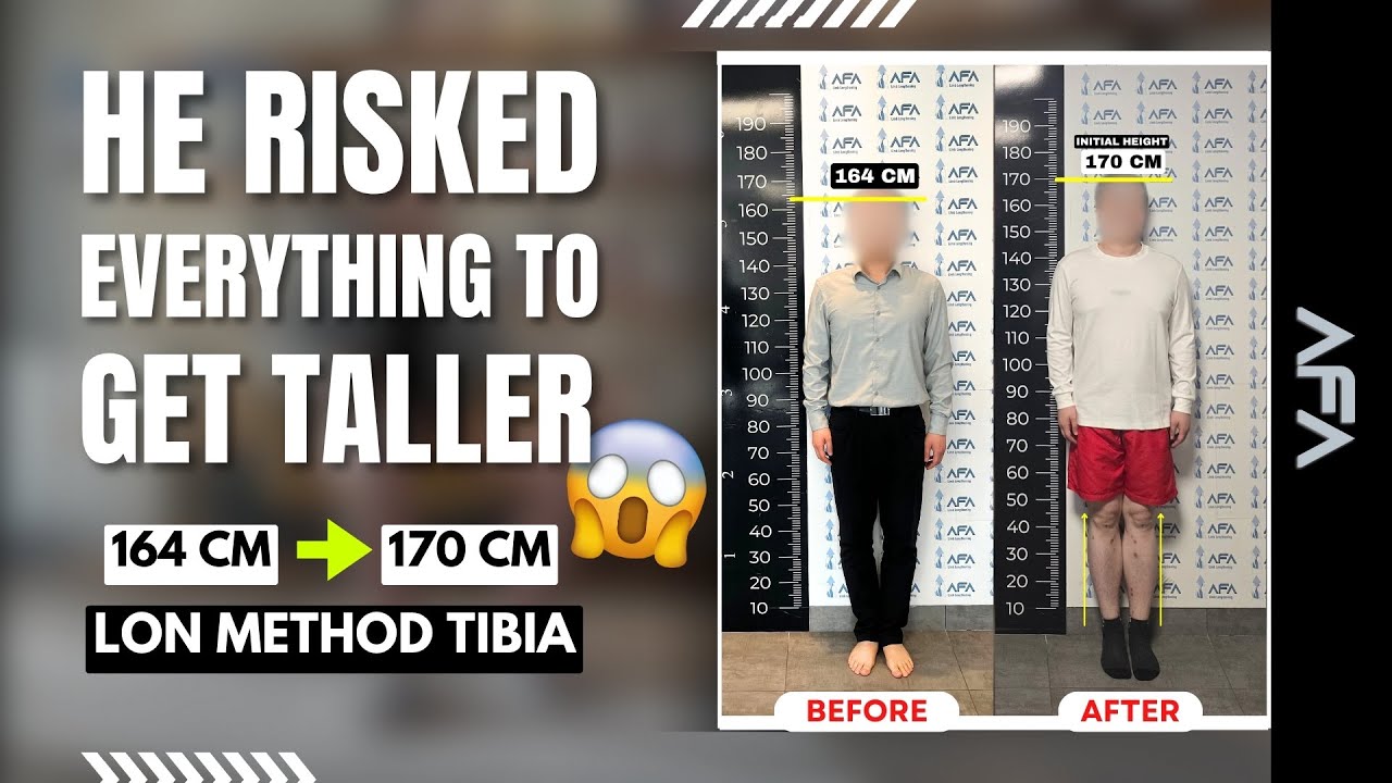 CHINA PATIENT’S LIMB LENGTHENING JOURNEY | +6 CM TALLER