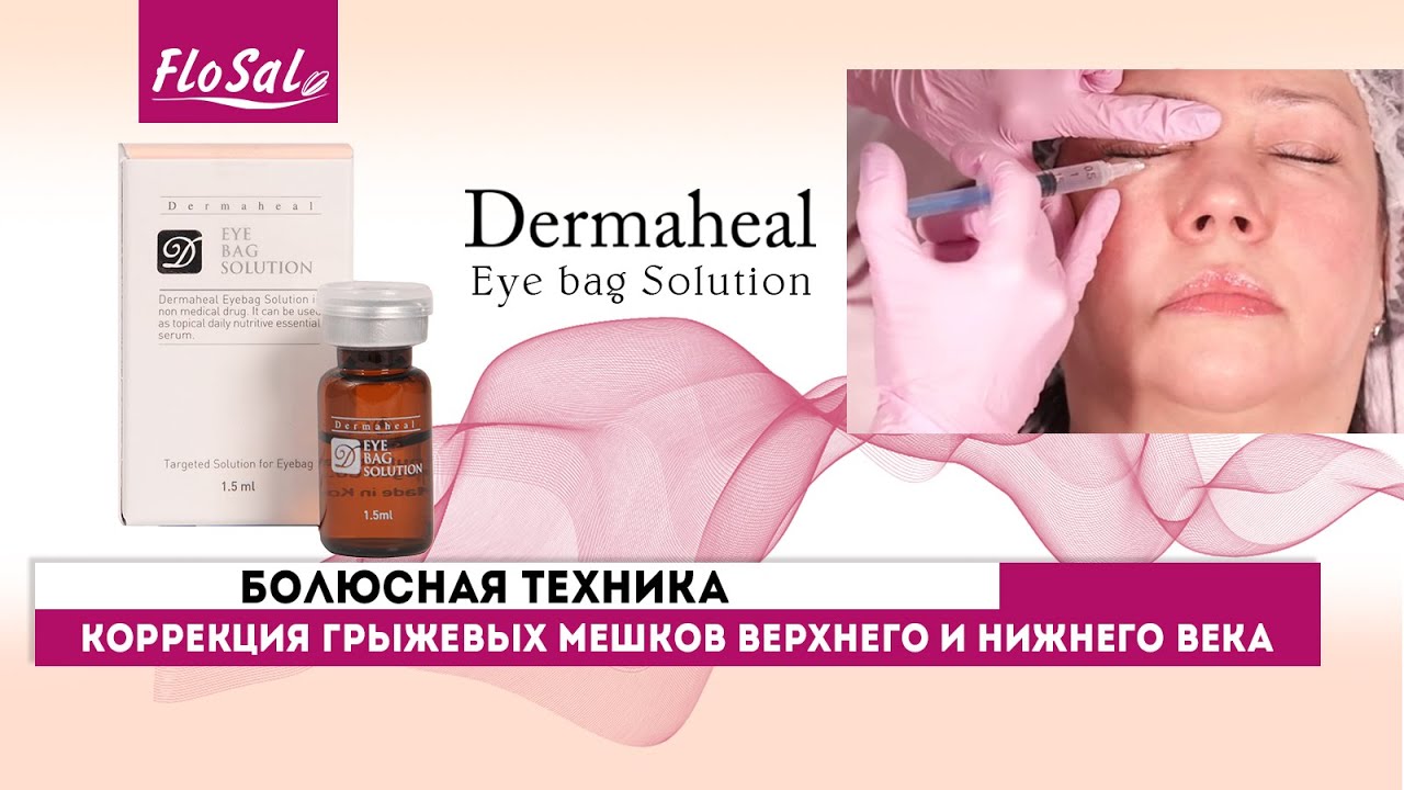 Коррекция грыжевых мешков верхнего и нижнего века препаратом Dermaheal Eyebag Solution