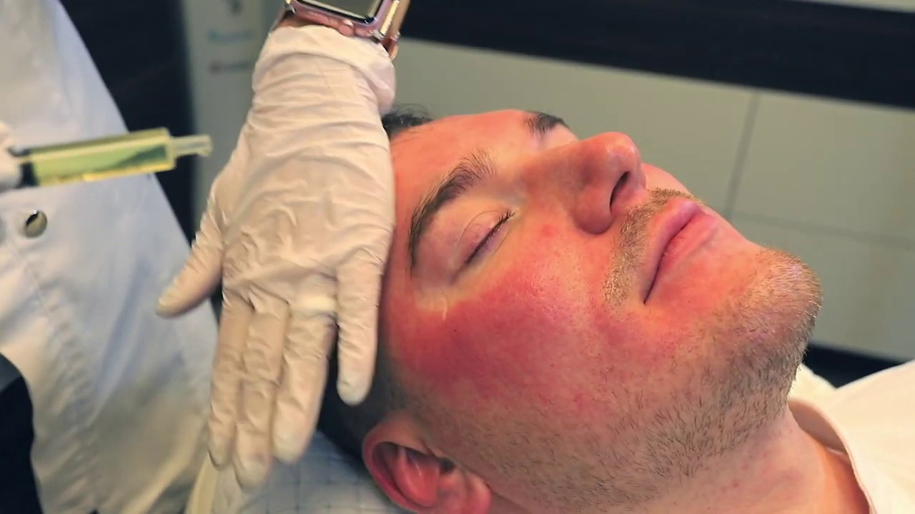 Microneedling und Medical Needling gegen Poren und als Anti-Aging