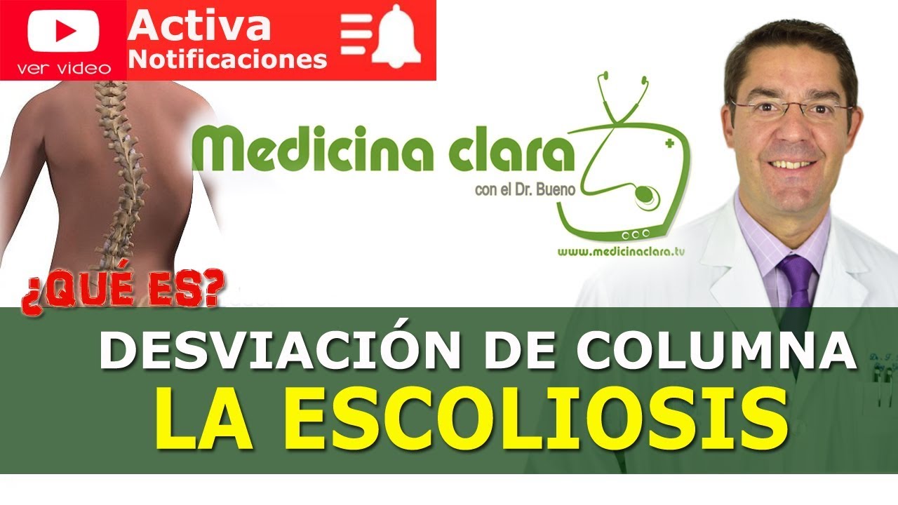Escoliosis, desviación de columna | Medicina Clara con el Dr. Bueno